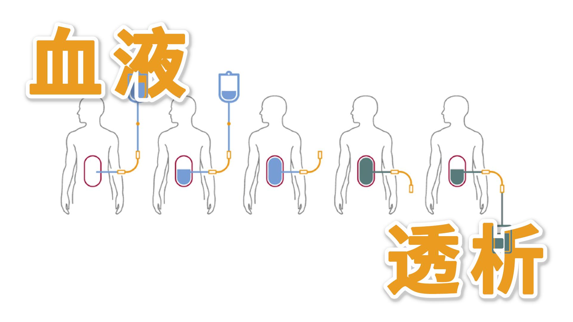 尿毒症的肾脏替代治疗方式,尿毒症替代治疗