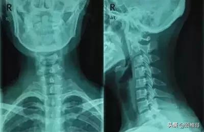 颈椎生理曲度反弓可以去健身房吗,颈椎病反弓原理