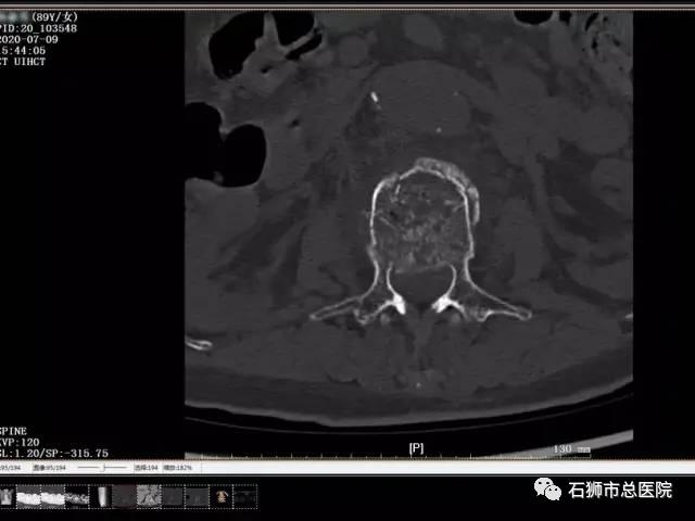 石狮市骨科医院,石狮市总医院骨科多少钱