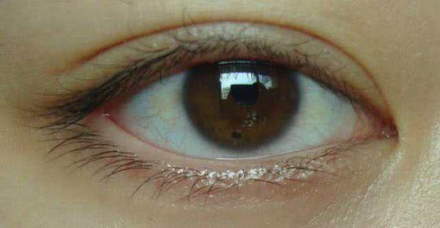 为什么眼白有黑色斑块,为什么眼白有的地方会黑块