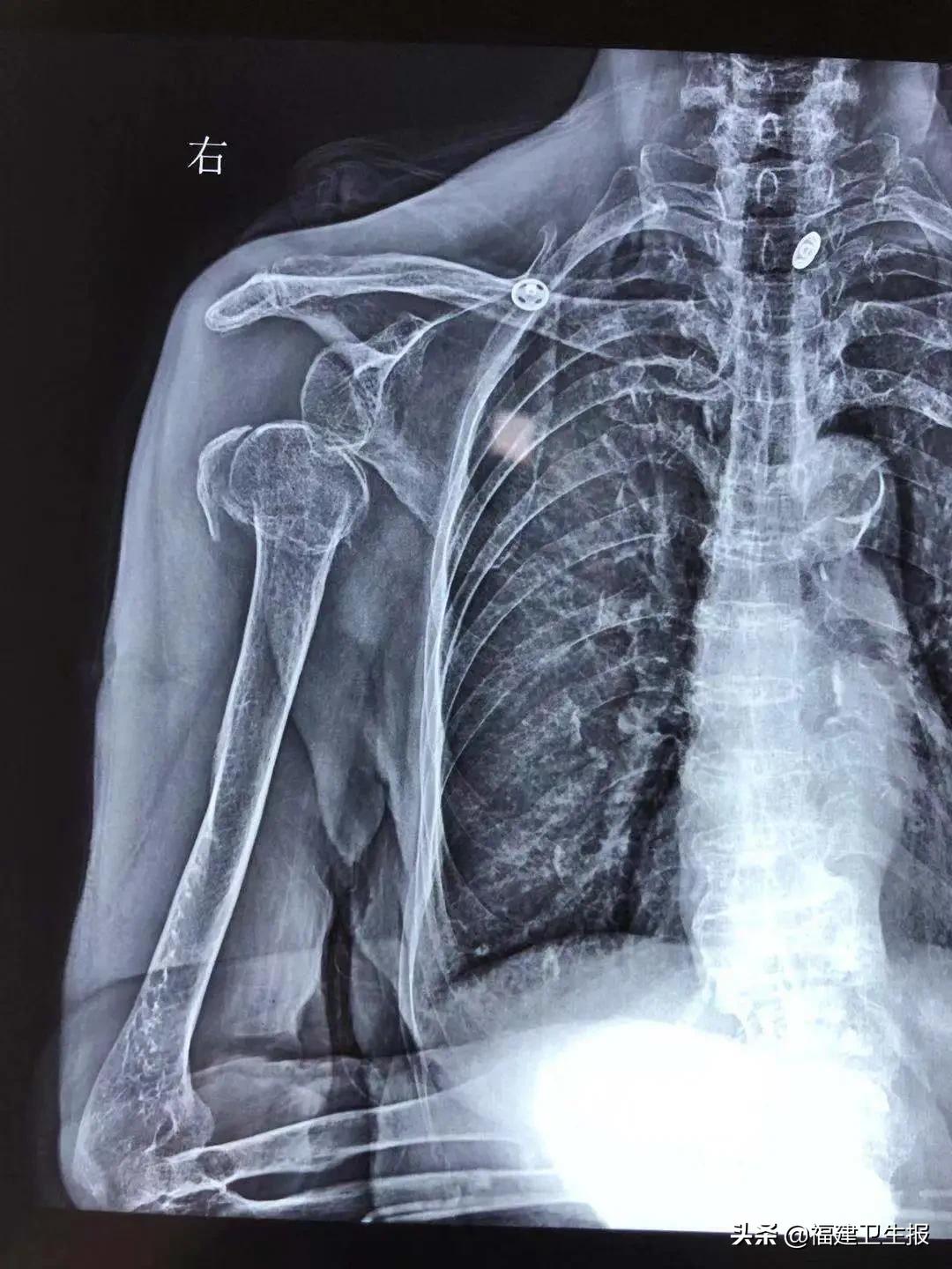 省内首例！福州95岁老奶奶滑倒后右肩骨折多次脱臼，医生成功为她“换肩”！