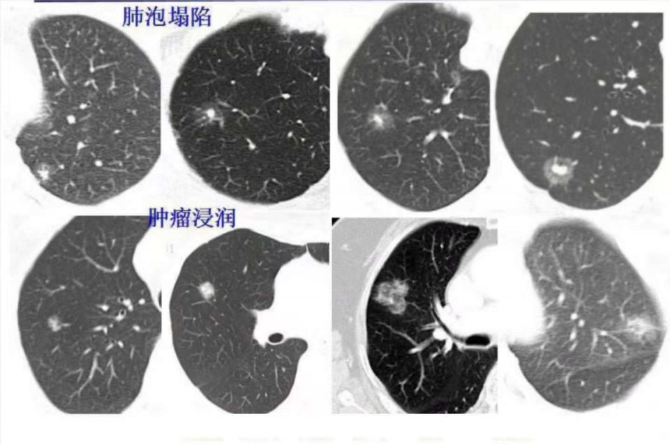 与肺癌病人一起生活需要注意什么,与肺癌抗战的第七个月