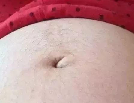 孕期肚子长毛生了会消下去吗,孕期肚子上长的毛生完会掉吗