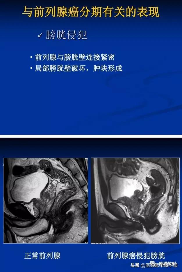 前列腺磁共振影像解剖,前列腺mri正常诊断报告模板