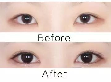 眼睛太圆了怎么修复双眼皮,眼睛已经是双眼皮太小了怎么变大