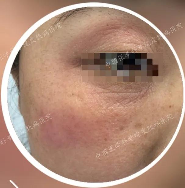 炎炎夏日如何正确护理皮肤,换季皮肤怎么防敏感