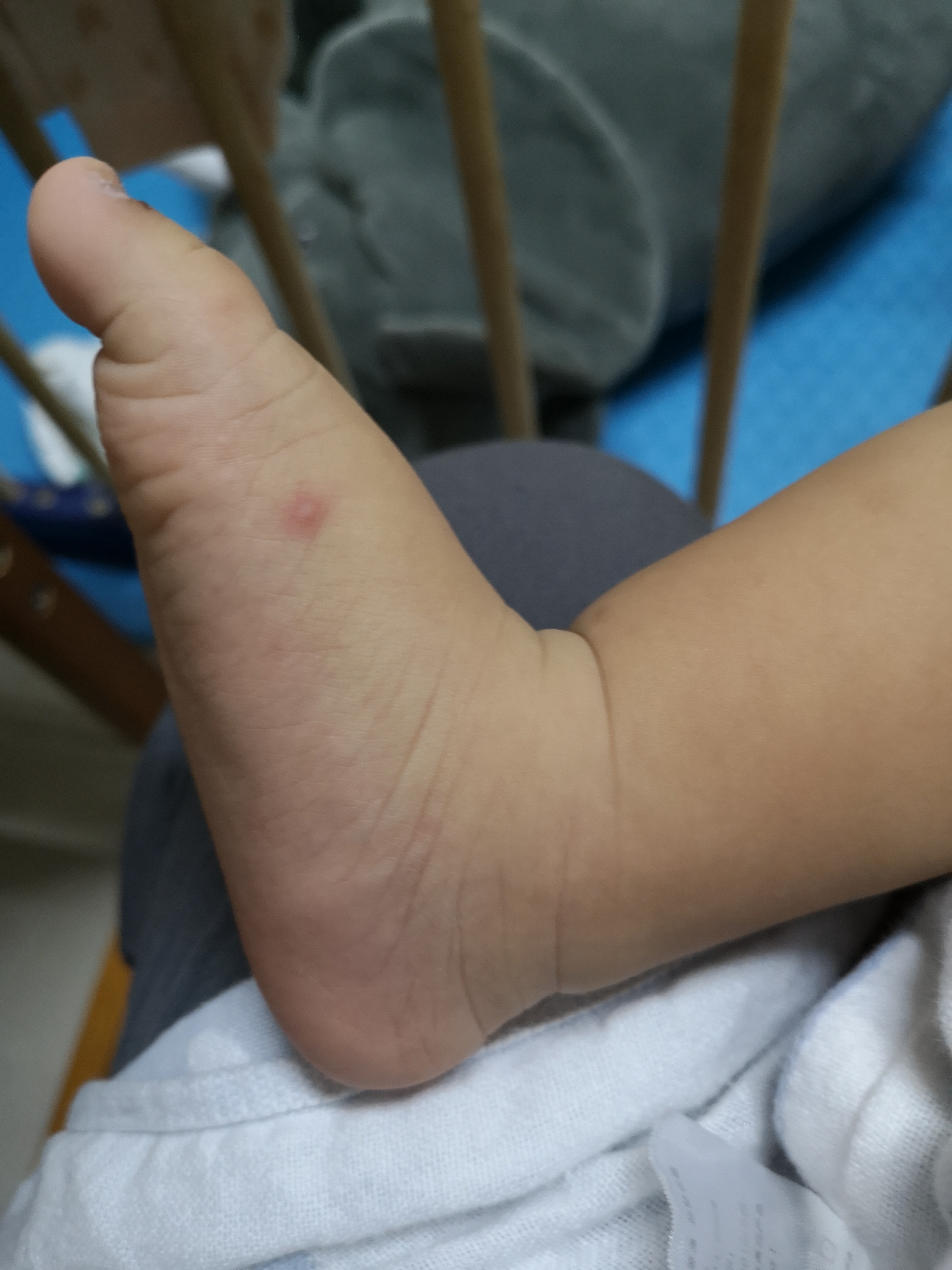 手足口病毒高发期,手足口高发期温馨提示