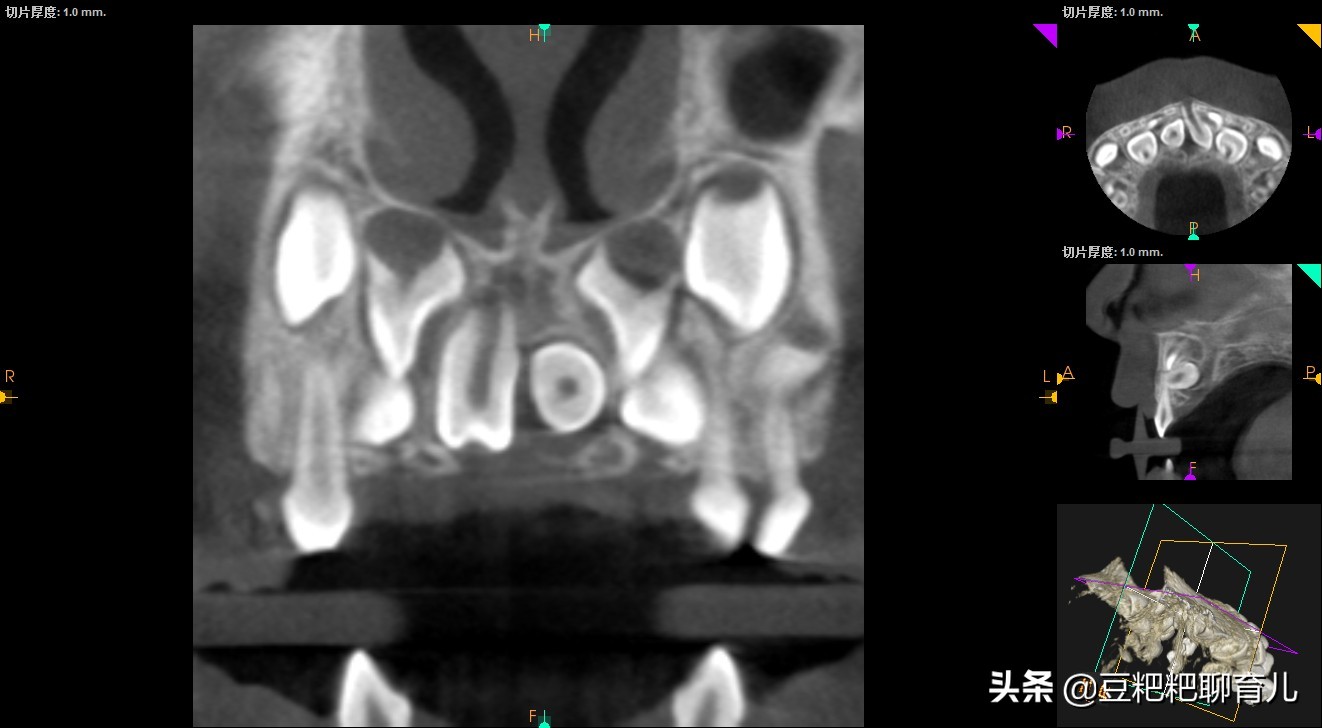孩子的牙齿疾病之一，越来越多的孩子有“多生牙”，你了解它吗？