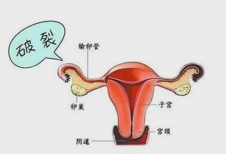 女子宫外孕,宫外孕大出血死亡事件