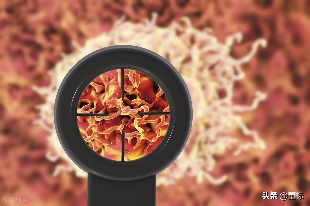 直肠癌晚期如何治疗,治疗直肠癌晚期药方