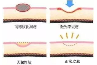医生不建议激光点痣,点痣医生