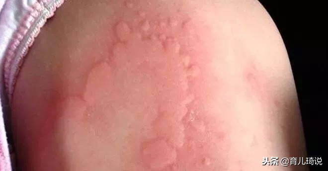 荨麻疹误以为慢性荨麻疹,小孩子荨麻疹科普知识