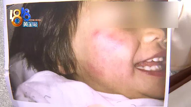 化妆品过敏小孩,孩子化妆过敏起疹子