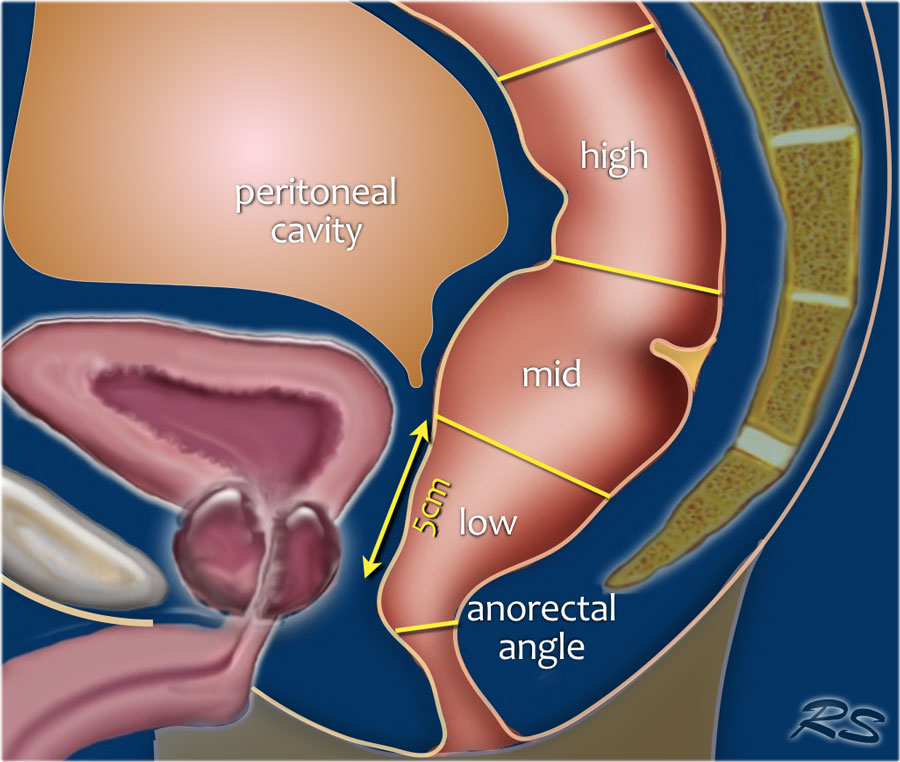 直肠癌“保肛”，你必须知道的知识