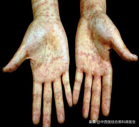 除了艾滋病，这4种常见性传播疾病你了解吗？