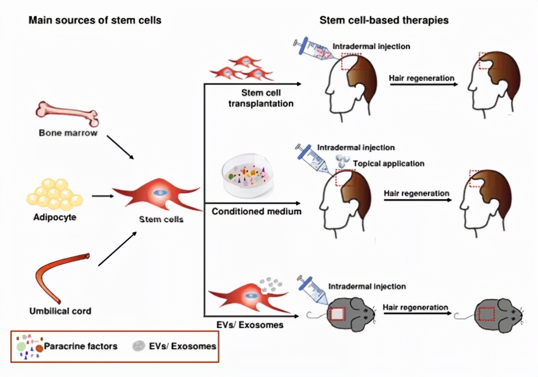干细胞治疗秃头最新消息,干细胞治秃头