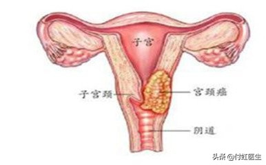 辟谣:房事过度宫颈肥大?