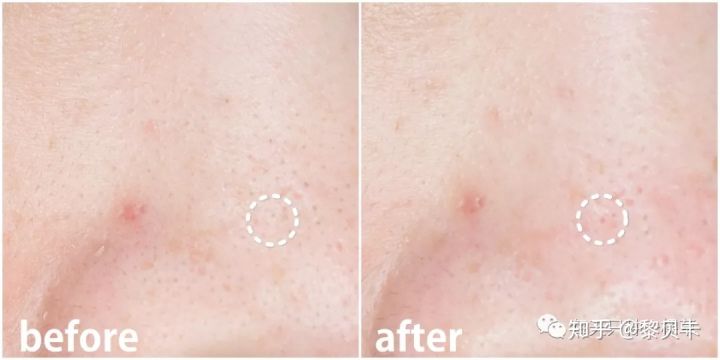 公认最好用的去黑头神器,网红推荐去黑头神器