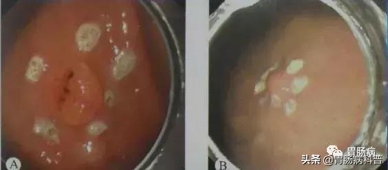 内镜下粘膜剥离术属于esd还是emr,胃肠息肉内镜下黏膜剥离术