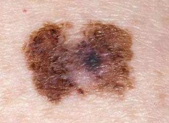 感染艾滋病早期症状多久会出现,你知道艾滋有什么症状不