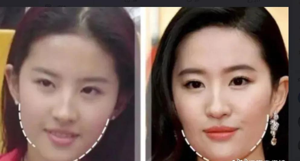 刘亦菲发腮什么意思,发腮的原因找到了