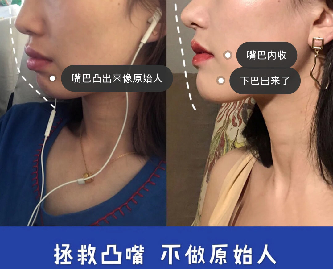 整牙讲解,整牙一定要问的问题