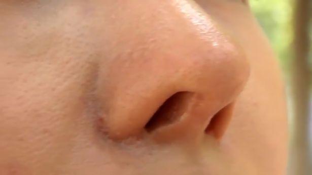 一女子整容成熊猫鼻,泰国妹子花150万整容