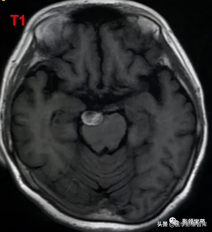 鞍区肿瘤做什么检查得出来,鞍区肿瘤的影像学鉴别