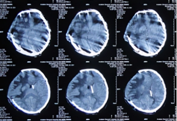 脑外伤开颅手术后脑积水,脑外伤手术后脑脊液鼻漏怎么治疗