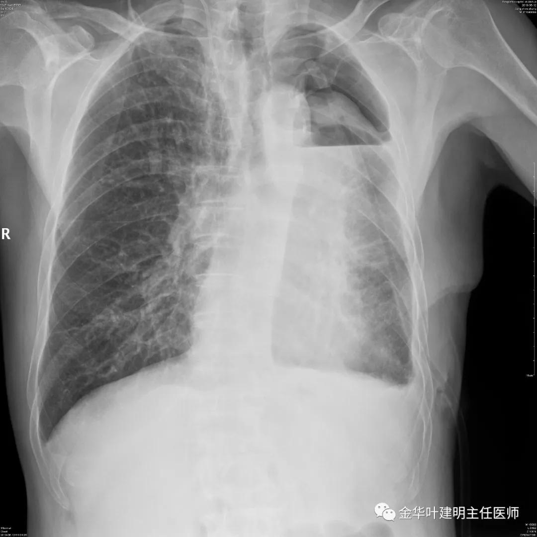 手术引起乳糜胸,有没有做了肺结节手术后是误诊的