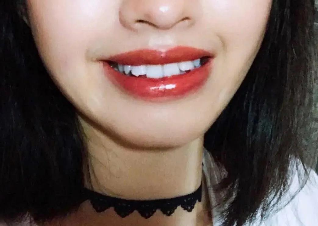 你知道吗？外力导致的牙齿脱落可以再植