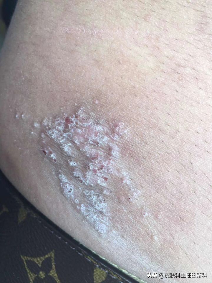 真菌感染性皮肤病原因,人真菌皮肤病怎么治