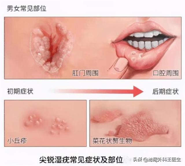 肛门摸到了小肉球，是痔疮还是尖锐湿疣？医生教你从外表区分