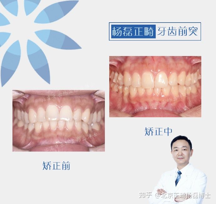 拔牙正畸治疗龅牙,门牙外突不拔牙正畸案例