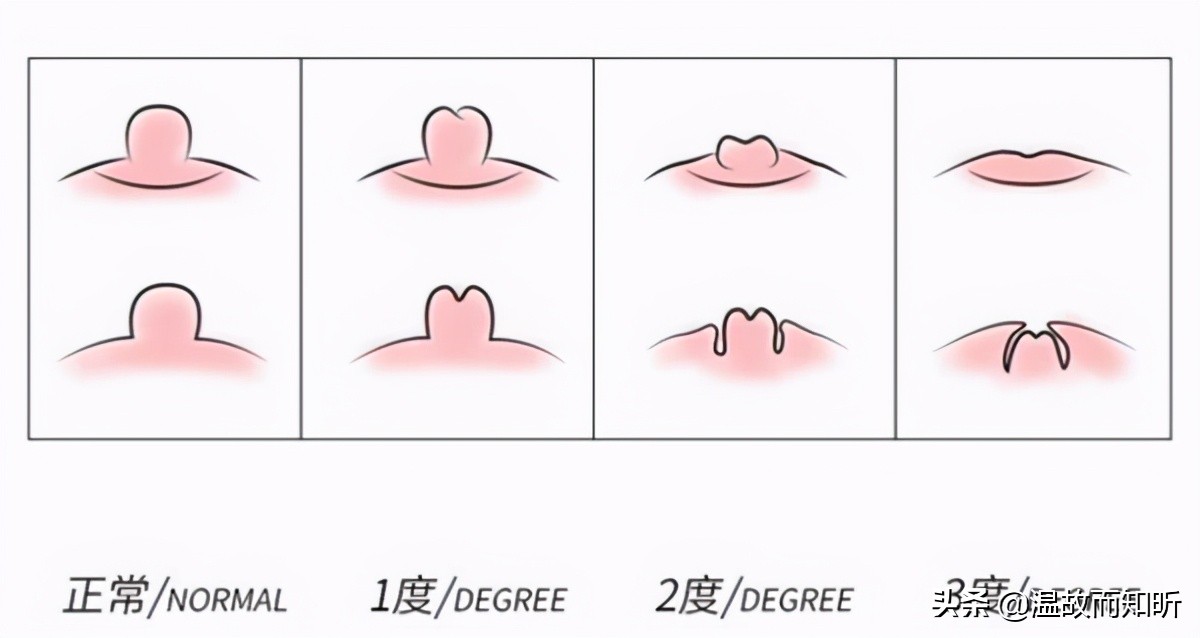 母女都是乳头内陷，检查出来的结果却不相同