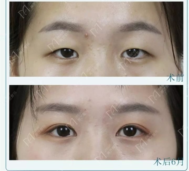 最好看的四种双眼皮内双,三种双眼皮哪种效果好