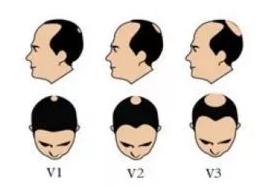 脱发的原因有哪些快点进来看看吧,出现这两种脱发别慌一招帮您搞定