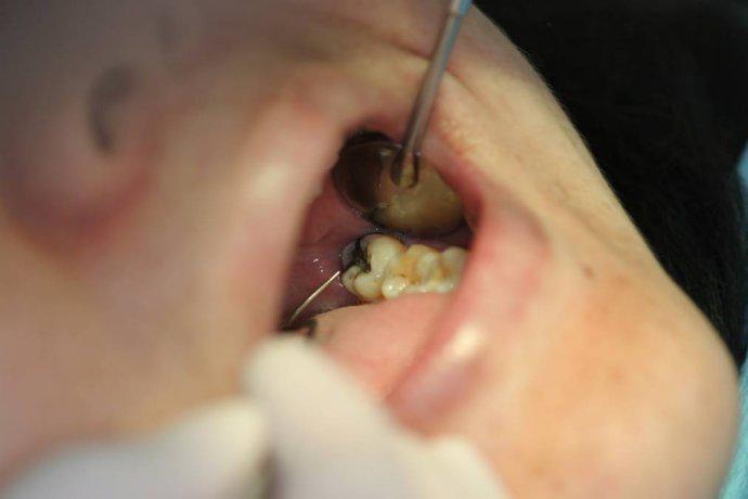 智齿蛀牙痛有什么有效方法止痛,智齿旁边牙松动蛀牙如何处理