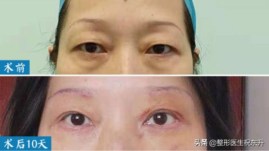 上眼皮松弛预示十种疾病,上眼皮松弛显凶