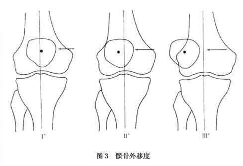 儿童习惯性髌骨脱位的手术治疗,儿童髌骨脱位怎么治疗最有效