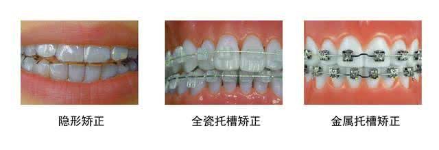 矫正牙齿你最关心的问题,矫正前需要问医生的问题