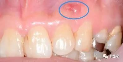 补完牙牙龈反复出现脓包怎么治疗,根管治疗的牙龈反复长脓包怎么办