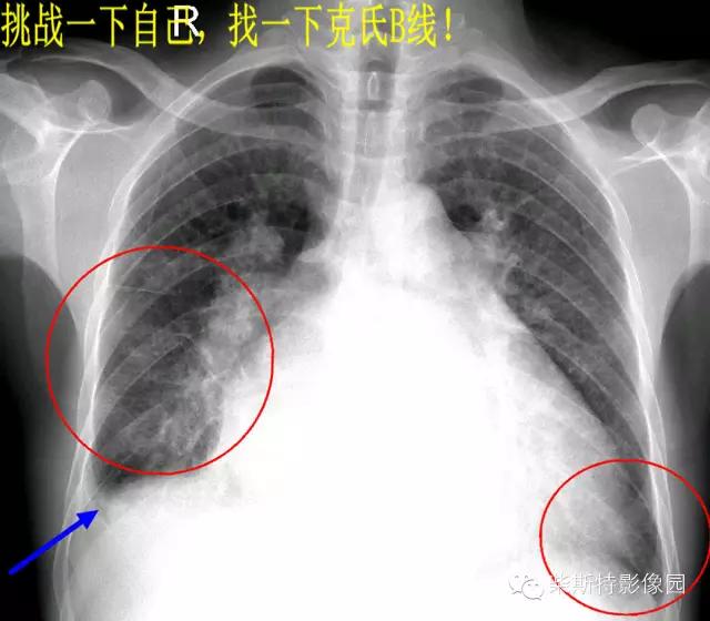 影像经典之KerleyA线、KerleyB线、KerleyC线