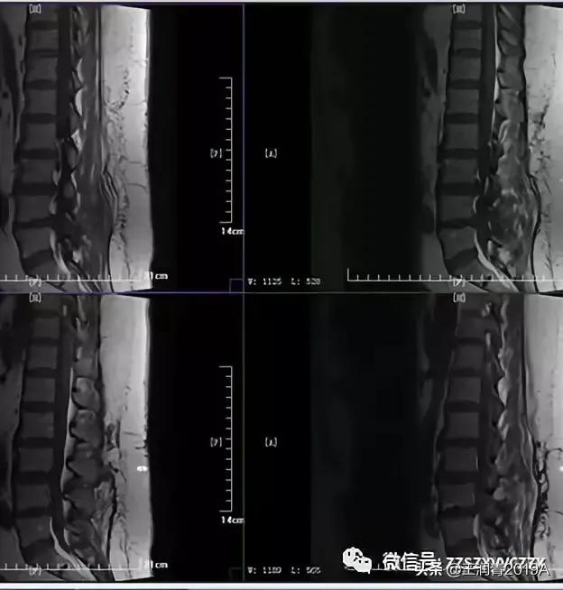弯腰捡东西,腰痛腿麻大小便*禁失**,竞是腰椎间盘髓核脱出惹的祸