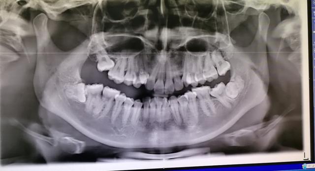 智齿老是发炎到底要不要拔掉,智齿总是发炎为什么牙医建议不拔