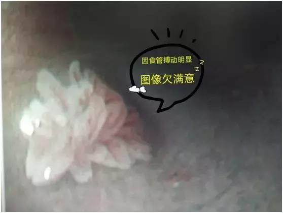 食管壁上美丽的“莲花”在无痛胃肠镜下现出了魔影