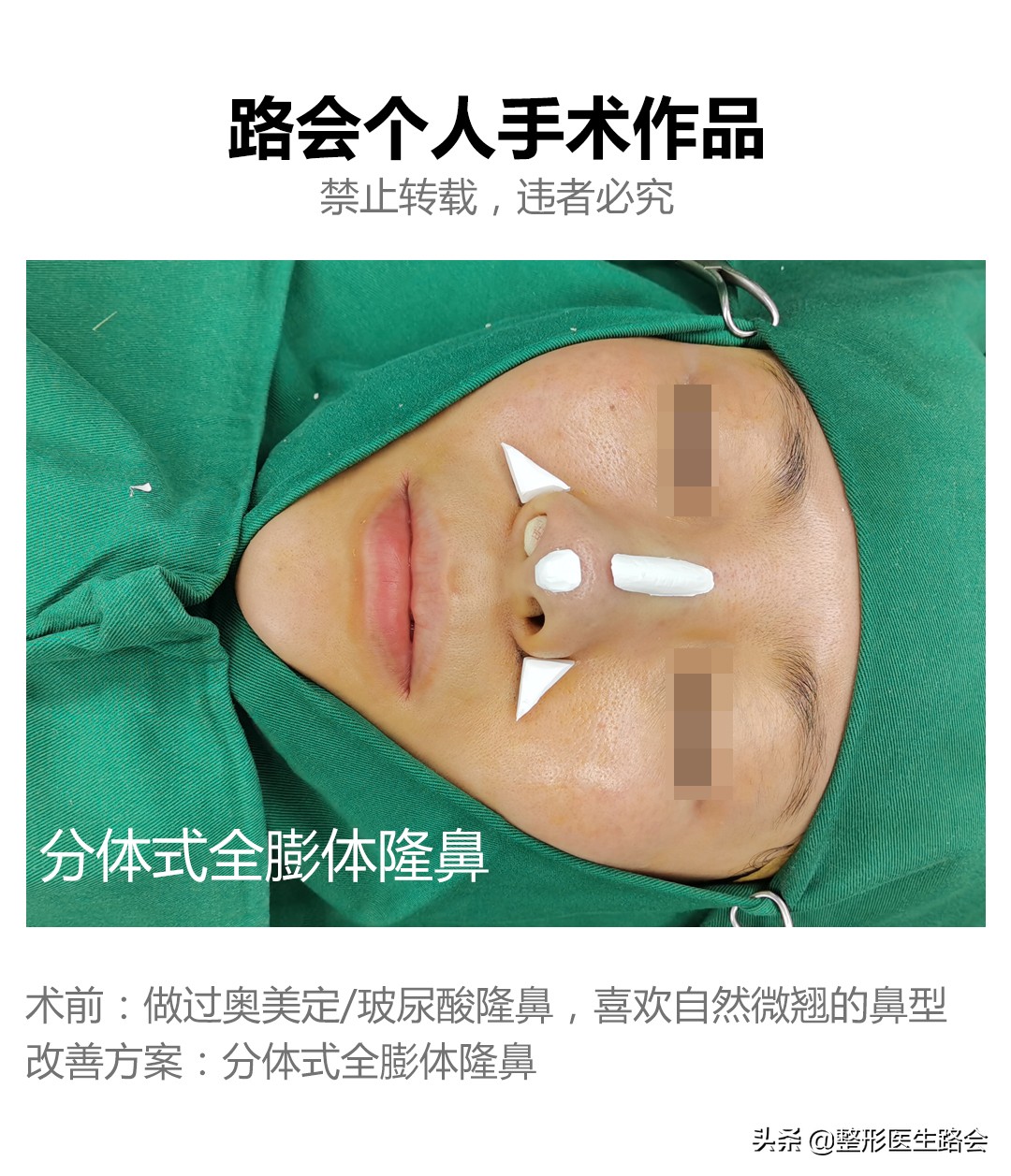 假体鼻子假吗,假体真的假吗