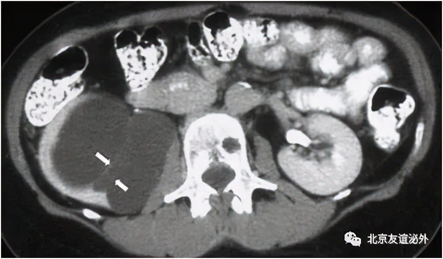 体检发现肾囊肿需不需要做手术,儿童体检发现肾囊肿