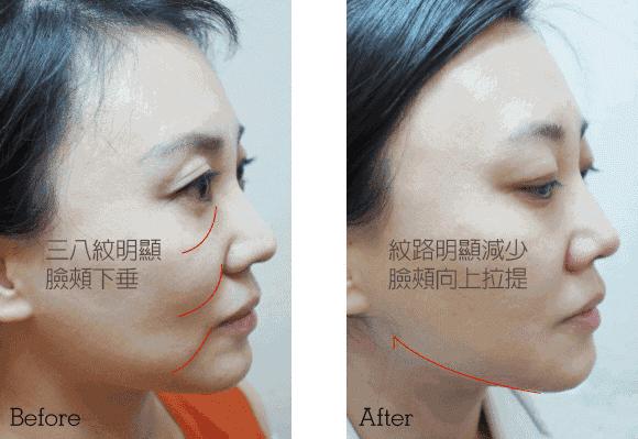 医生不说的医美副作用,医生不会说的真相