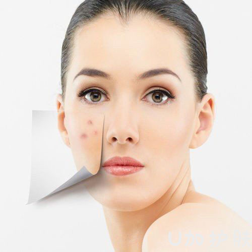 脸上痘痘换季越来越多5招防痘痘,换季长痘痘的正确护肤方法